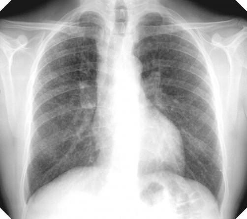 Silicosis-Silica-Dust_1 - CFMEU WA
